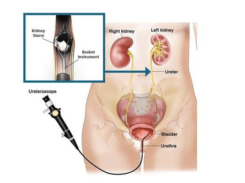 Cirurgia a laser de pedra nos rins pós-operatório