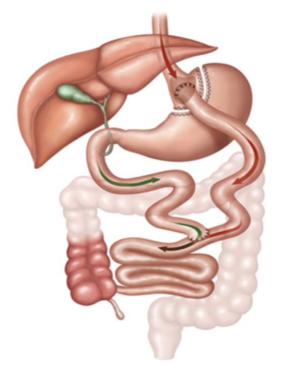 bypass-gastrico-em-y-de-roux